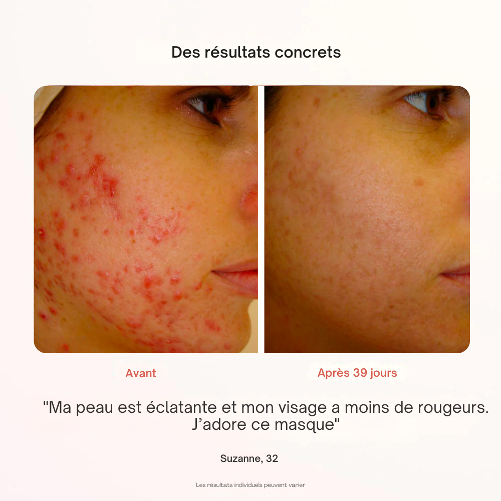 Masque Professionnel de Photothérapie