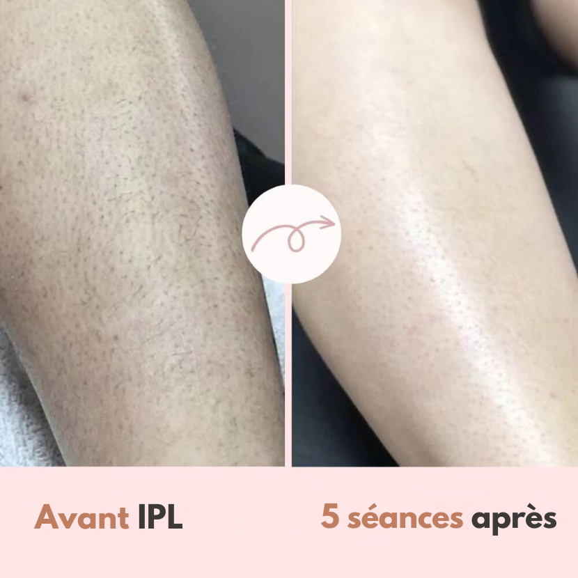 Épilateur Diamond IPL