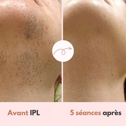 Épilateur Diamond IPL