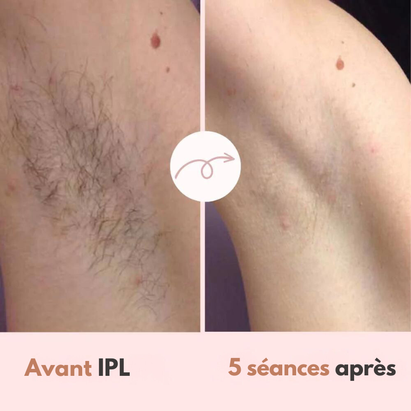 Épilateur Diamond IPL